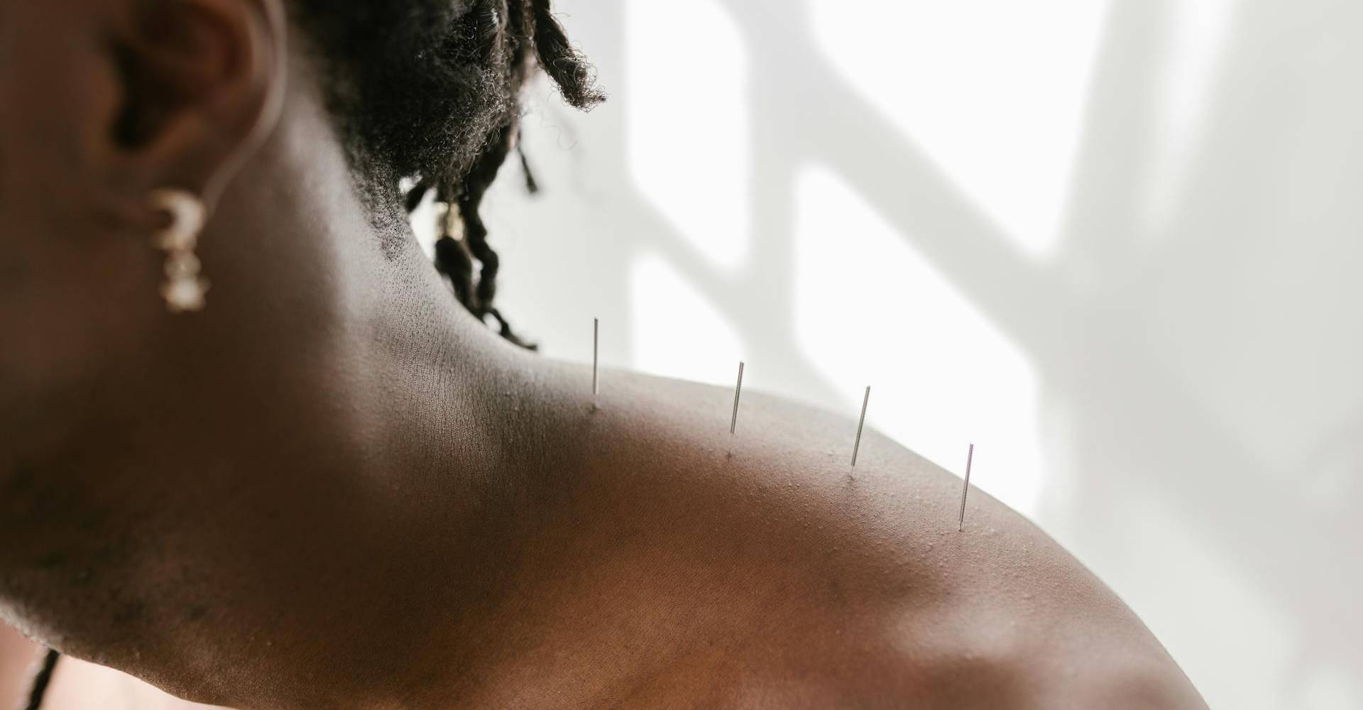 Acupuncture Session