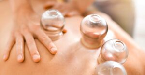 Cupping Therapy